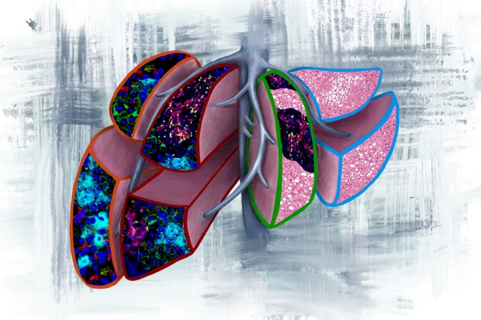 Image illustrating four prognostic scenarios found in liver biopsies when pancreatic cancer is diagnosed before metastasis.