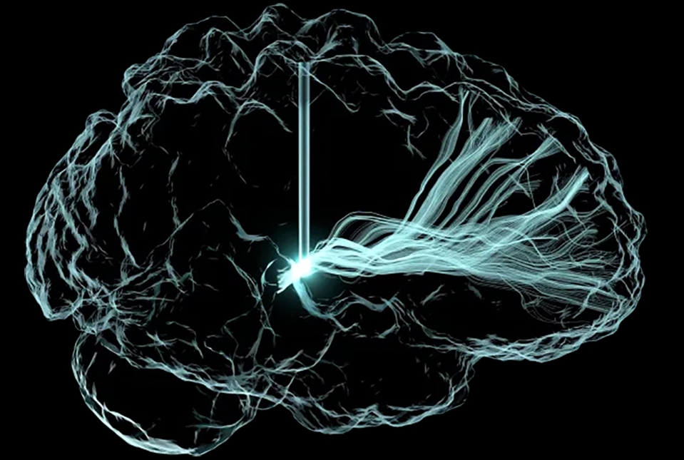 image of brain with electrode and nerve fibers