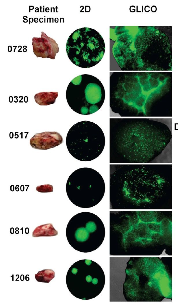 GLICO models recapitulate patient-derived cell line behavior via differentiated patterns of invasion.