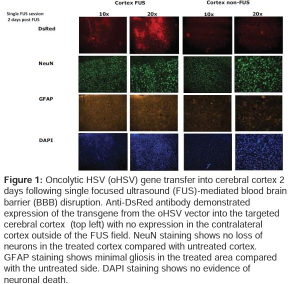 Figure: oncolytic HSV (oHSV) gene transfer into cerebral cortex 2 days following single focused ultrasound (FUS)-mediated blood brain barrier (BBB) disruption.