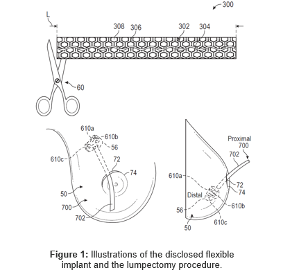 Illustrations of the disclosed flexible implant and the lumpectomy procedure.