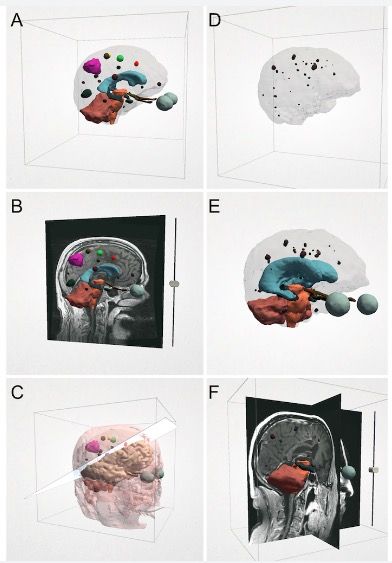 NeuroVis holograms for a patient undergoing stereotactic radiosurgery planning for treatment of a resection cavity with metastasis (A-C) and for a patient with multiple intracranial metastases (D-F).