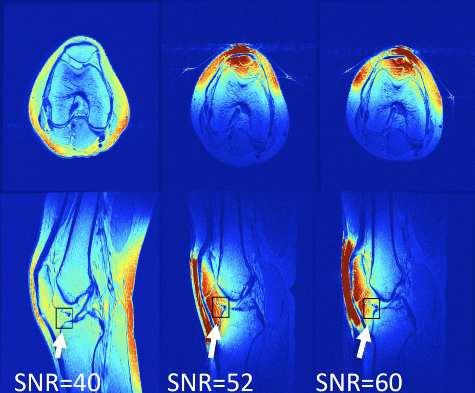 Figure: prototype of proposed RF coil shows higher SNR compared to a commercial knee coil array.