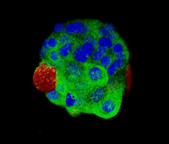 Breast tumor organoid