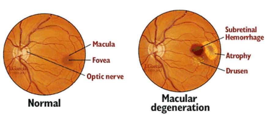 Image of Normal and AMD Pathology