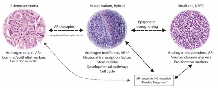 Working model of lineage plasticity in prostate cancer.