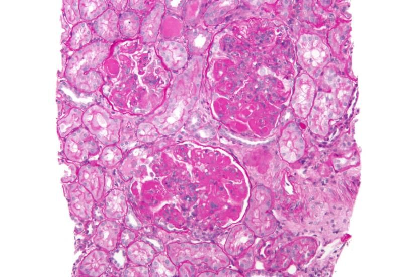 Diffuse proliferative lupus nephritis.