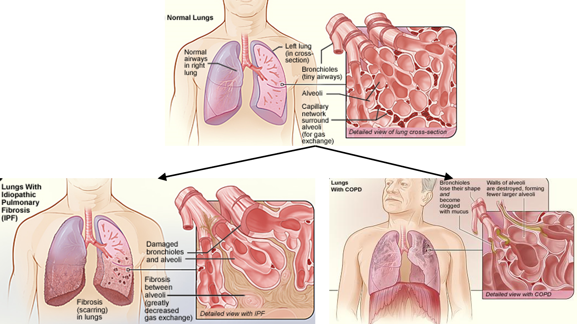 Illustrated example of lung damage in IPF and COPD