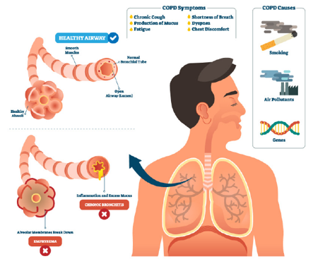 Pathology of COPD.